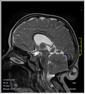 нейрохирургическая операция – иссечение затылочной черепно-мозговой грыжи пациентке 2,5 лет в НПЦ медпомощи детям им. Войно-Ясенецкого