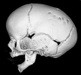 операция ребенку в возрасте 3,0 мес. с сагиттальным краниосиностозом (скафоцефалия) с выраженной деформацией черепа  – эндоскопическая краниосиностозэктомия в НПЦ медпомощи детям им. Войно-Ясенецкого