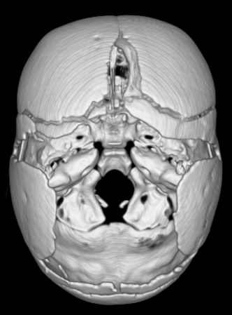 операция ребенку в возрасте 3,0 мес. с сагиттальным краниосиностозом (скафоцефалия) с выраженной деформацией черепа  – эндоскопическая краниосиностозэктомия в НПЦ медпомощи детям им. Войно-Ясенецкого