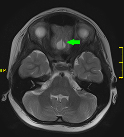 удаление арахноидальной кисты медио-базальных отделов лобных долей головного мозга в НПЦ медпомощи детям им. Войно-Ясенецкого